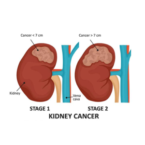 Early-Stage-Kidney-Cancer