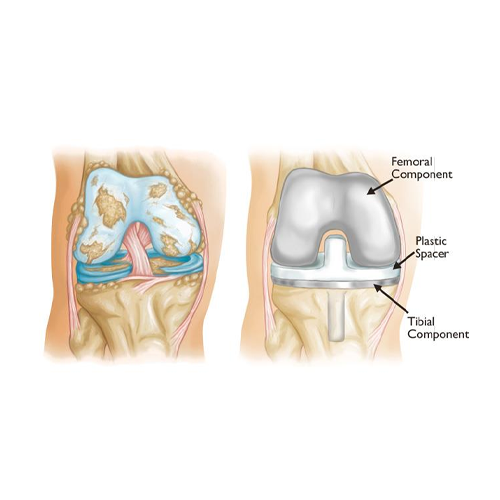 Comprehensive-Surgical-Treatment-Plan-for-Knee-Joint-Replacement