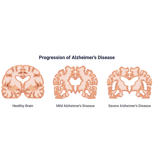 Comprehensive-Treatment-Plan-for-Alzheimer’s-Disease-in-Germany