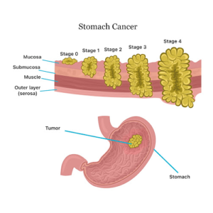 German cancer doctor