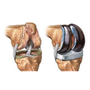Knee-Joint-Replacement