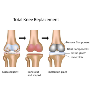 Knee-Joint-Replacement