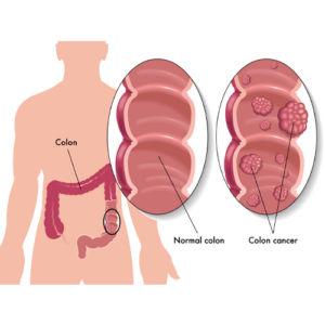 Offer-HIPEC-for-Peritoneal-carcinomatosis-from-colorectal-canceradvanced-prop-1