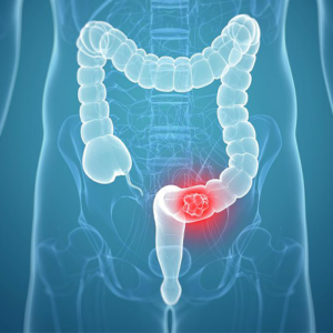 Offer-HIPEC-for-Peritoneal-carcinomatosis-from-colorectal-canceradvanced-prop2
