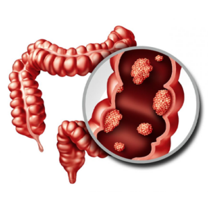 Offer-HIPEC-for-Peritoneal-carcinomatosis-from-colorectal-canceradvanced-prop3-1