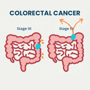 Offer-HIPEC-for-Peritoneal-carcinomatosis-from-colorectal-canceradvanced-prop4