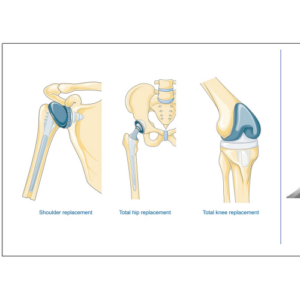 Orthopedic-Surgeries-Types-Definitions-Costs-and-Hospital-Stay-Durations-with-diagram.png2_